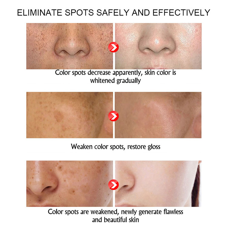 freckle cream manufacturer