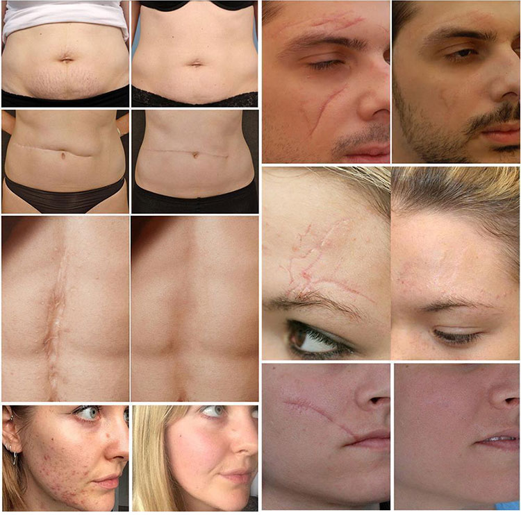 scar remover cream wholesaler