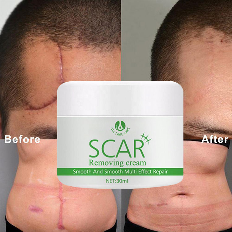 scar removing cream